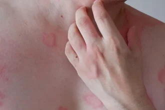 Bercak Merah di Kulit Tanpa Gatal, Tanda Penyakit Apa?